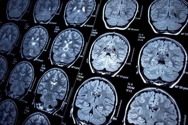 image of black and white brain scans