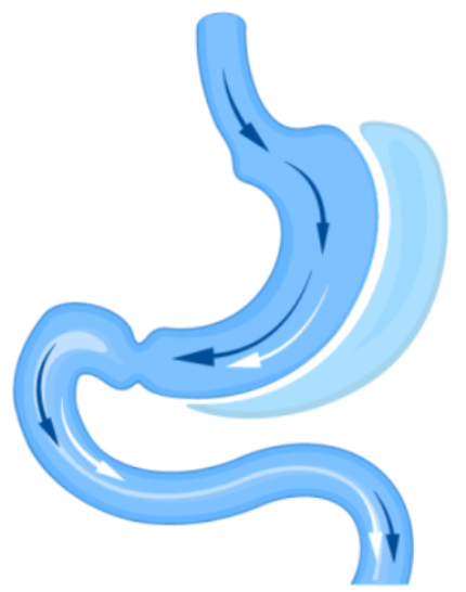 Gastric sleeve stomach surgery diagram